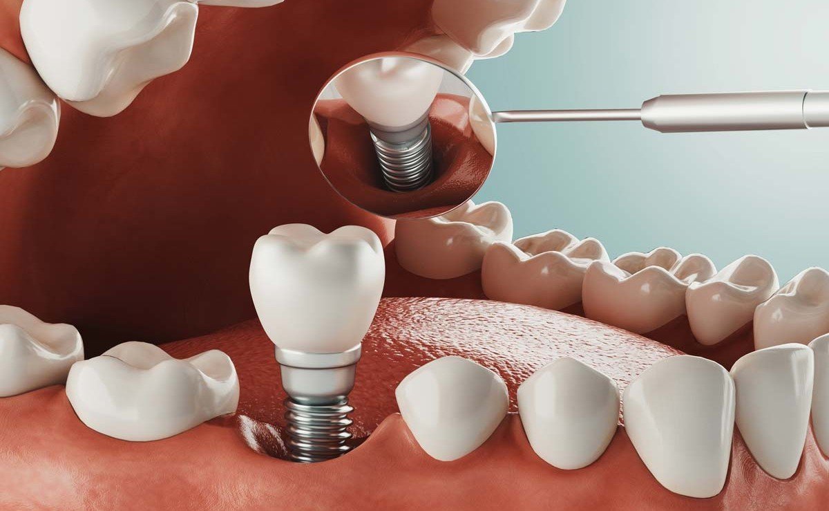 Dental implants at Om Sai Ram Dental Clinic