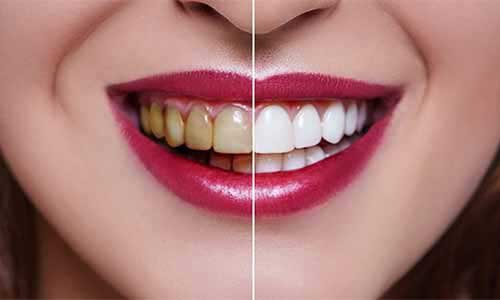 Teeth whitening at Om Sai Ram Dental Clinic